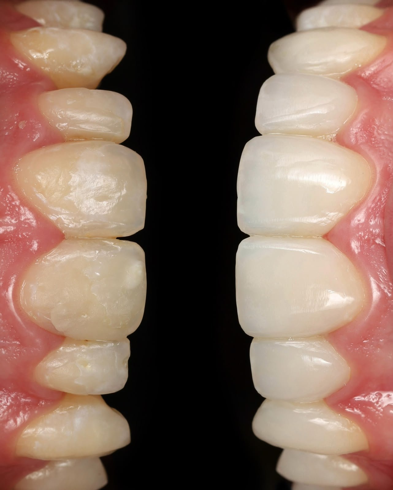 Caso de estética dental 1