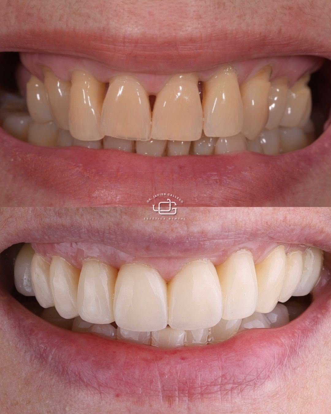 Caso de estética dental 2